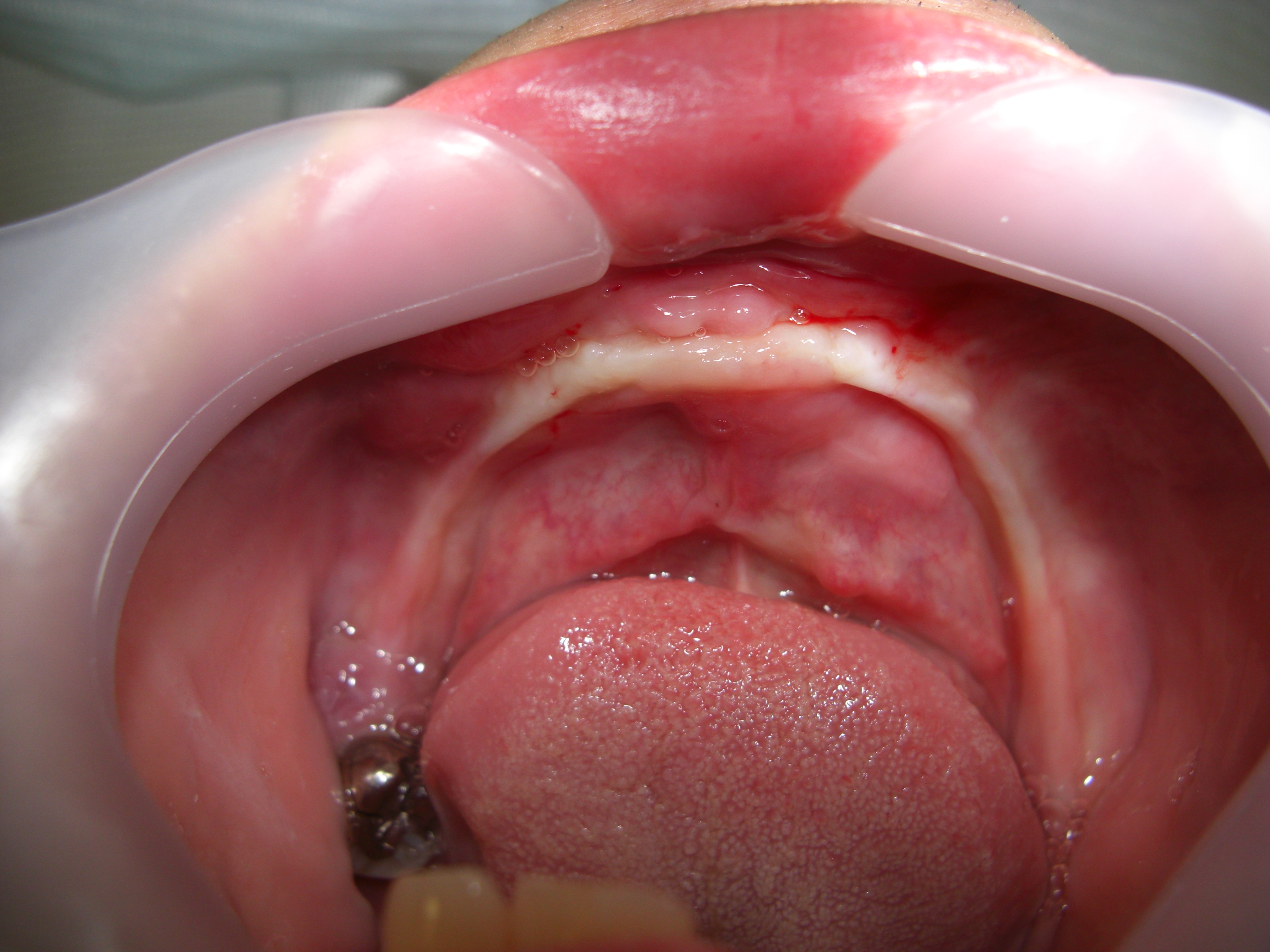 入れ歯の人工歯の排列