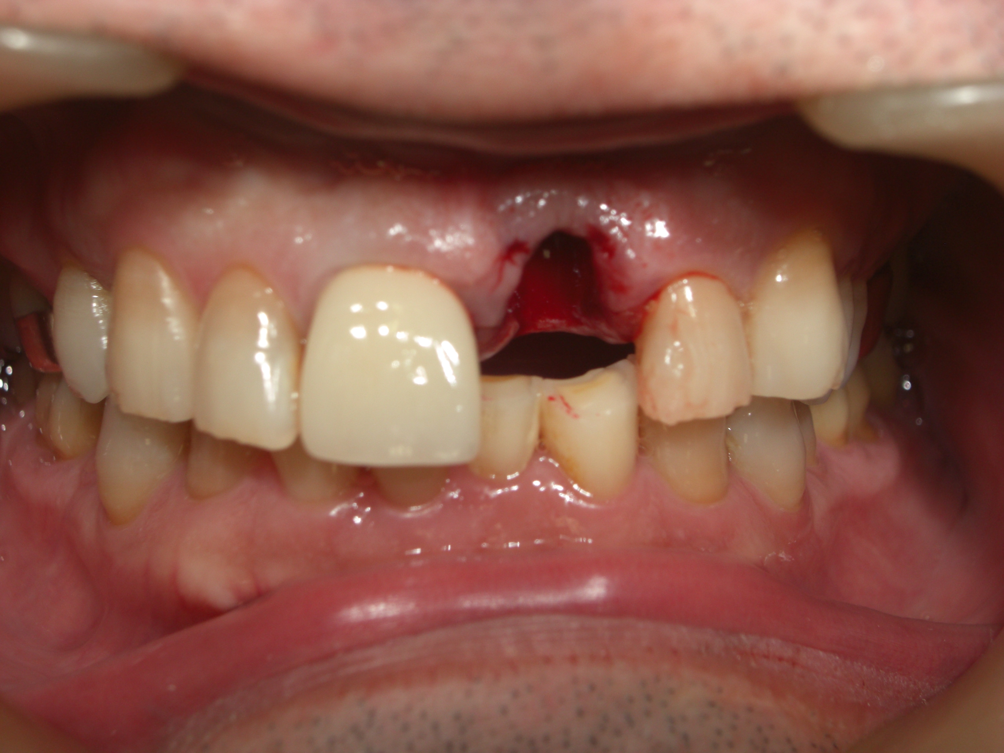前歯部の歯根破折により抜歯した当日にインプラントを埋入したケース