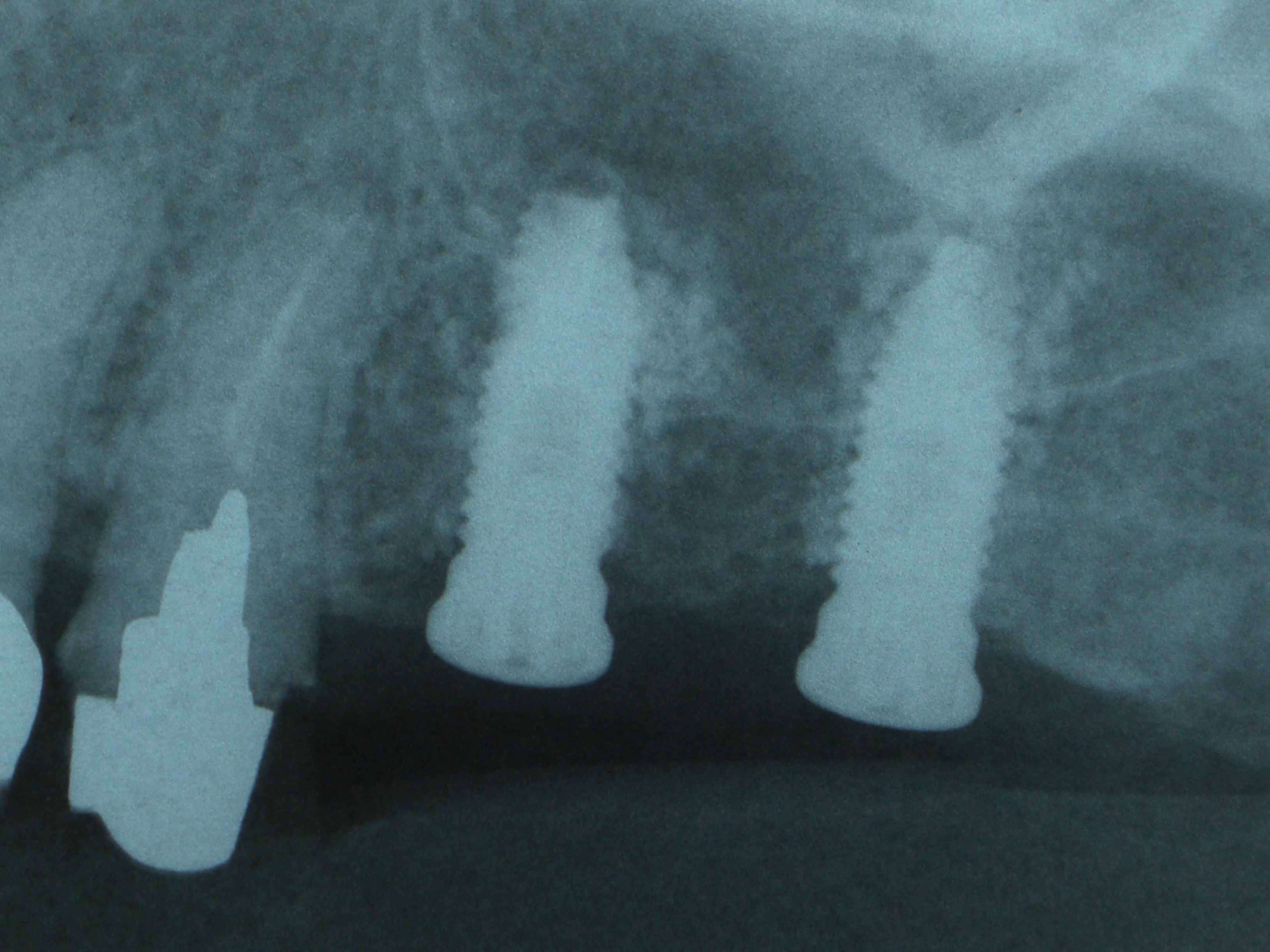 骨補填と同時にインプラント埋入したレントゲン