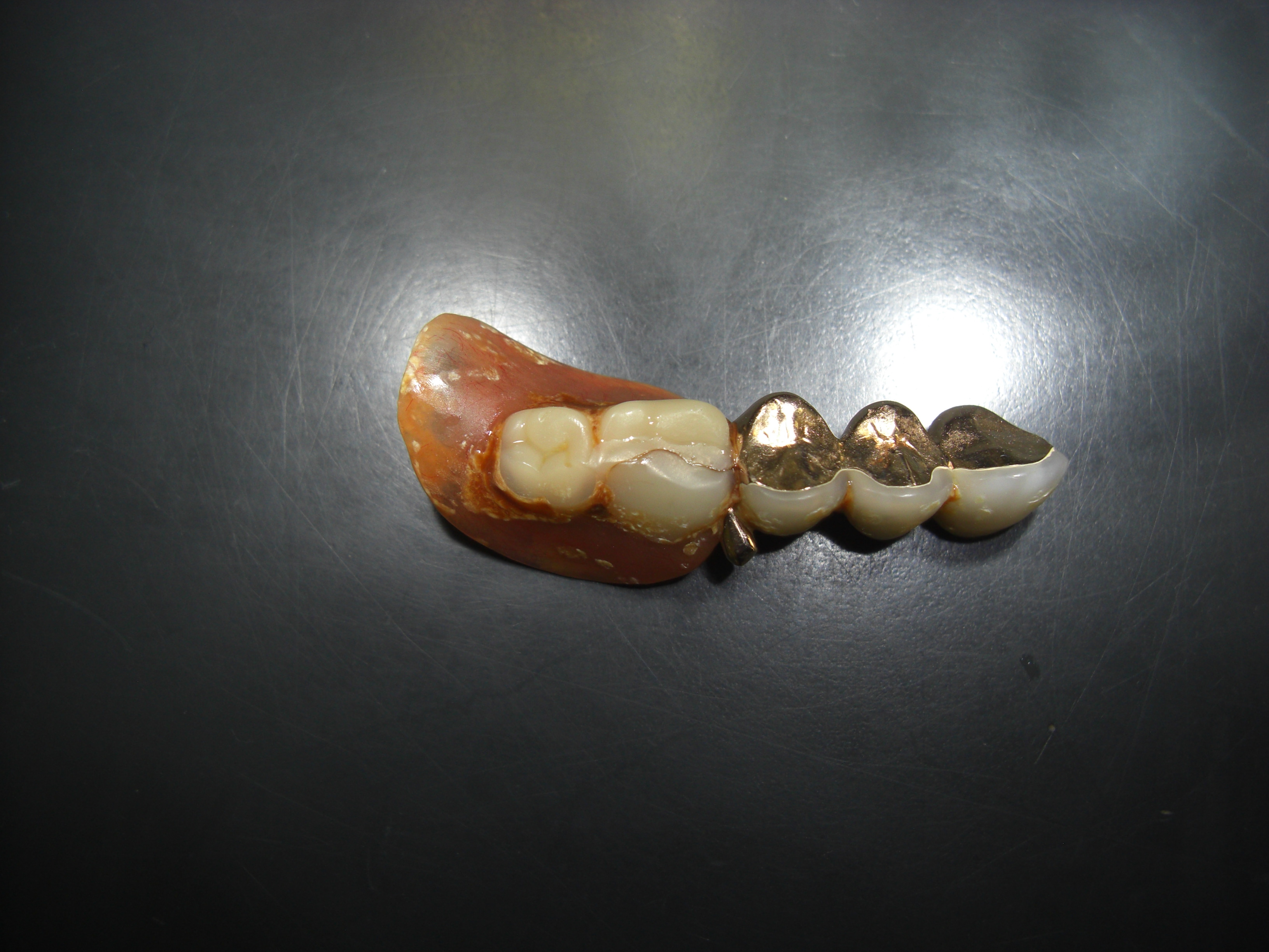 コーヌス義歯により大臼歯部を補綴したケース