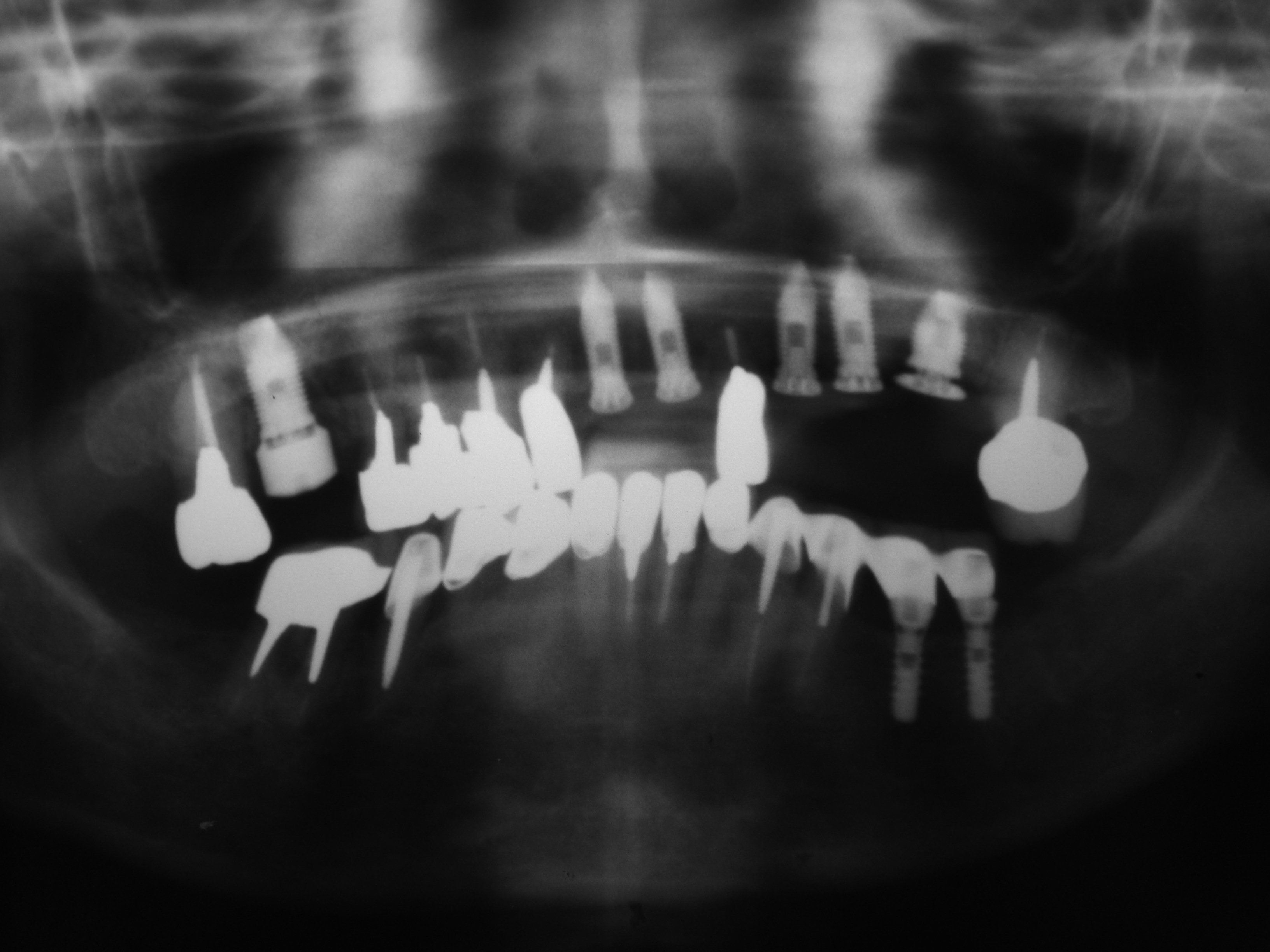 インプラント埋入後のレントゲン